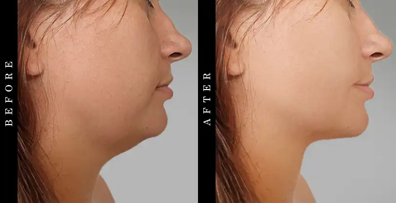 Drmtlgy Neck Cream Before and After