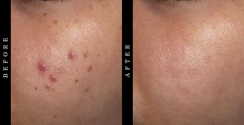 Clear Pores Acne Treatment Before and After