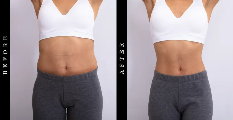 TriTrim Before and After